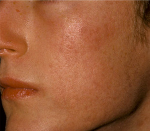 Correzione acne Dopo