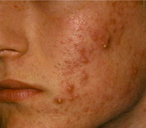 Correzione acne Prima